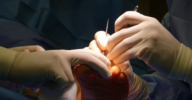 traitement des infections fongiques du pied : découvrez les solutions efficaces pour soigner les mycoses, soulager les symptômes et prévenir leur récidive.